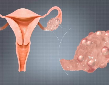 Yumurtalık Kisti Kimlerde Görülür ? Nasıl yok olur ?