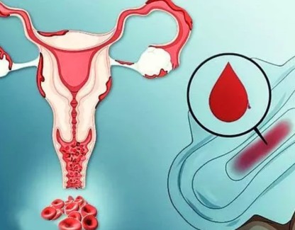 İmplantasyon ( Yerleşme ) Kanaması Nedir Ne Zaman Olur