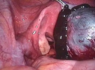 Rahim Kanseri (Endometrium)