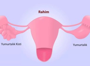 Yumurtalık Kistleri