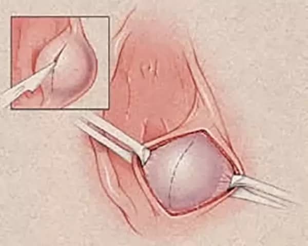 Bartholin-kisti-nedir-2-600x480