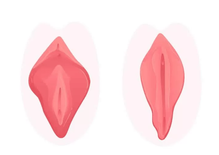 labioplasti-tedavisi-718x510