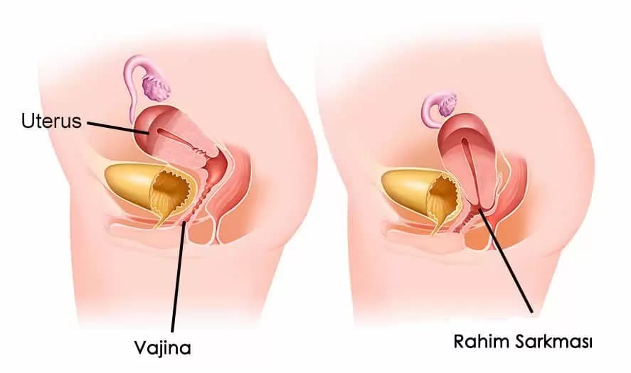 rahim-sarkmasi-nasil-tedavi-edilir-887x525