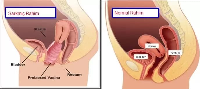 rahim-sarkmasi-nedir-688x307